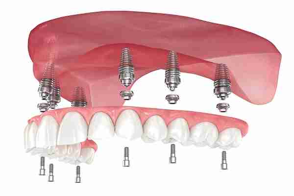 The Complete Guide to Implant Dentures: What You Need to Know