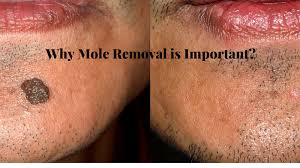 Best Mole Removal NYC