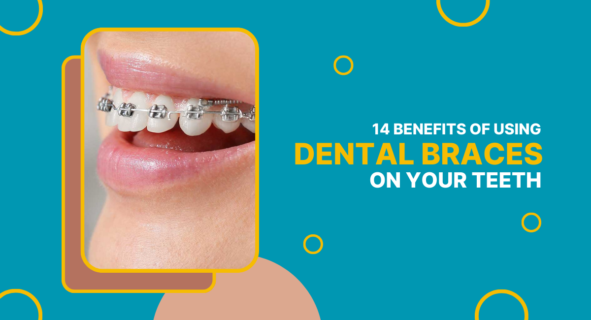 14 Benefits of Using Dental Braces on Your Teeth
