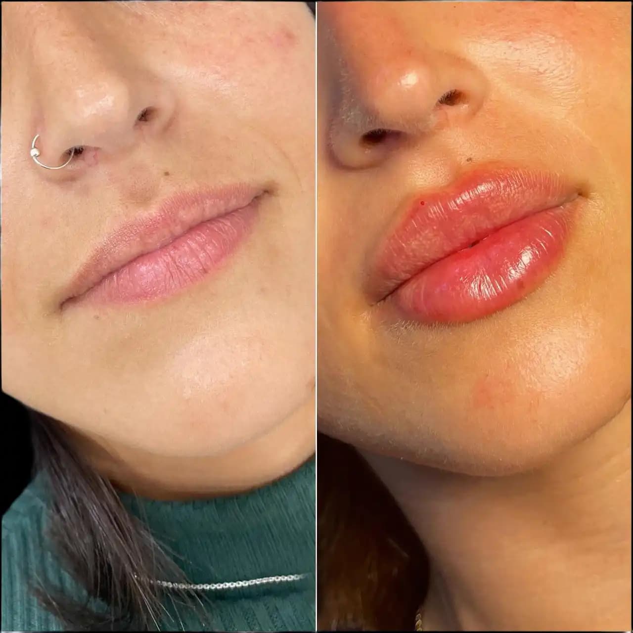 Lip Fillers in Dubai: Before & After Expectations