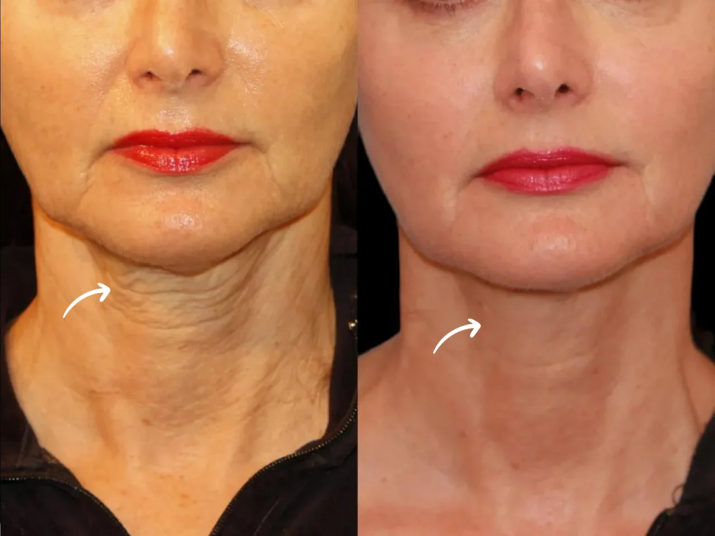 How to Achieve Subtle, Natural Results with Sculptra Fillers in Dubai