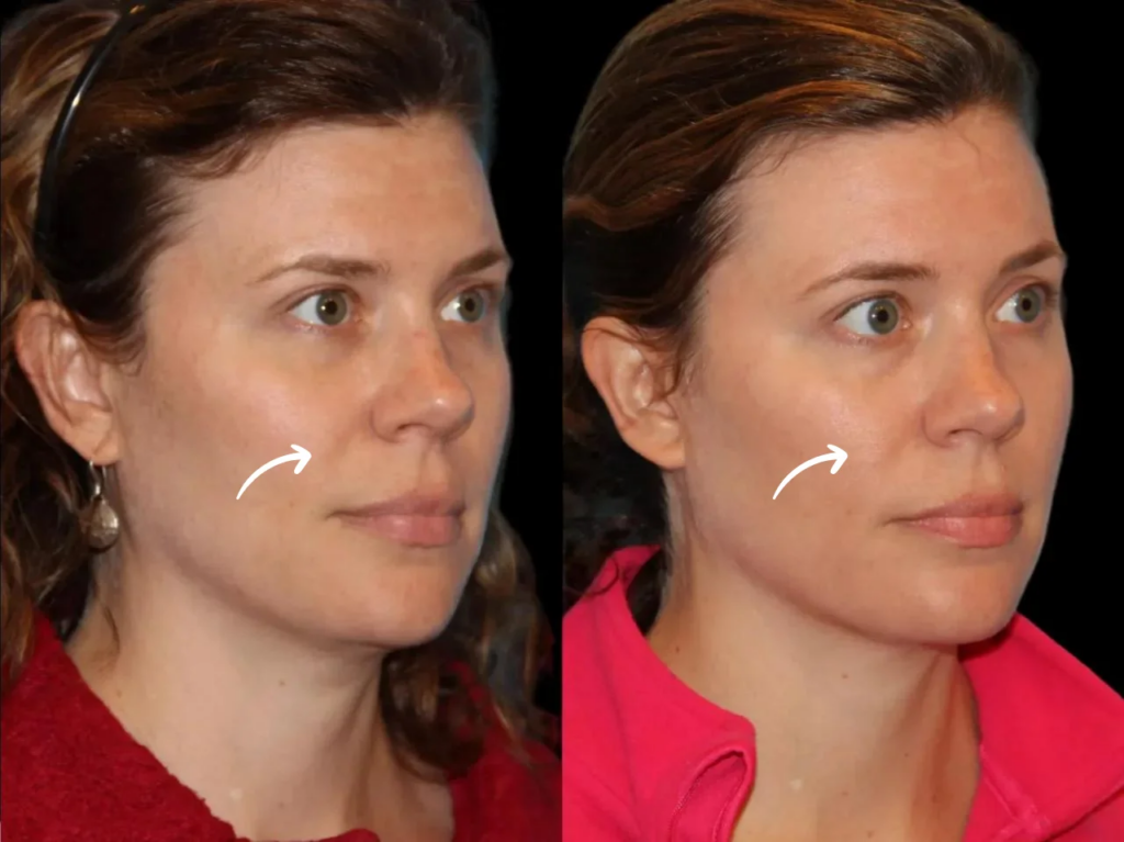 Enhancing Skin Radiance with Sculptra Fillers Treatment in Dubai