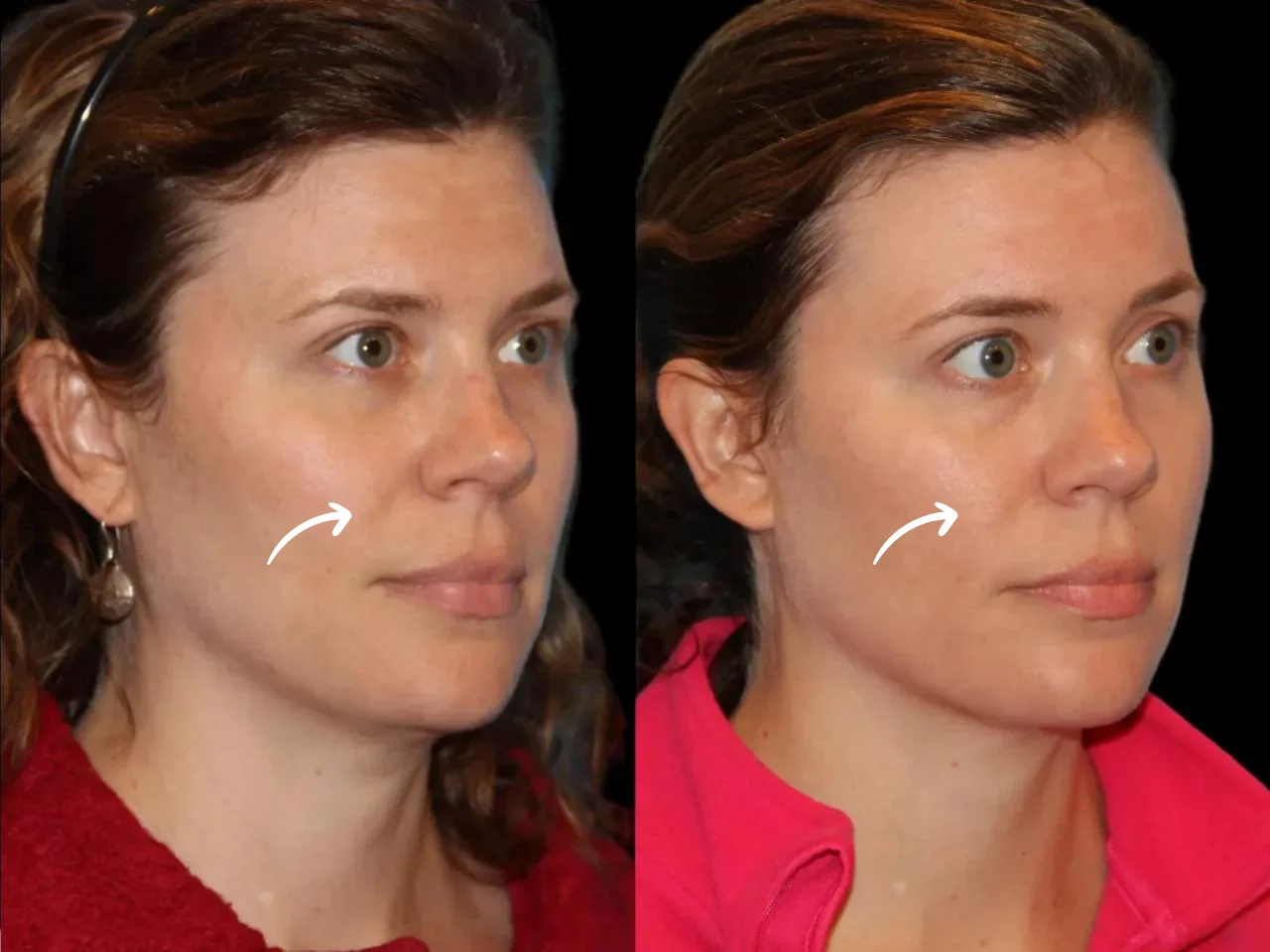 Enhancing Skin Radiance with Sculptra Fillers Treatment in Dubai