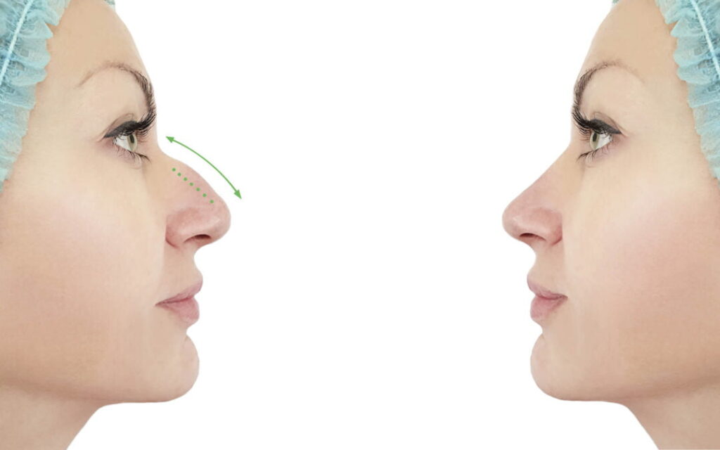 Is Rhinoplasty Suitable for All Nose Shapes?