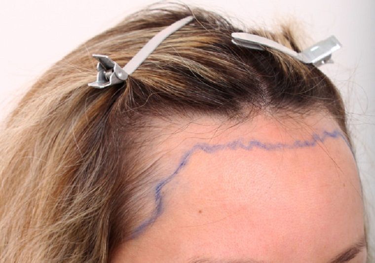 Effective Hair Restoration in Regina: How to Achieve Fuller, Healthier Hair Naturally