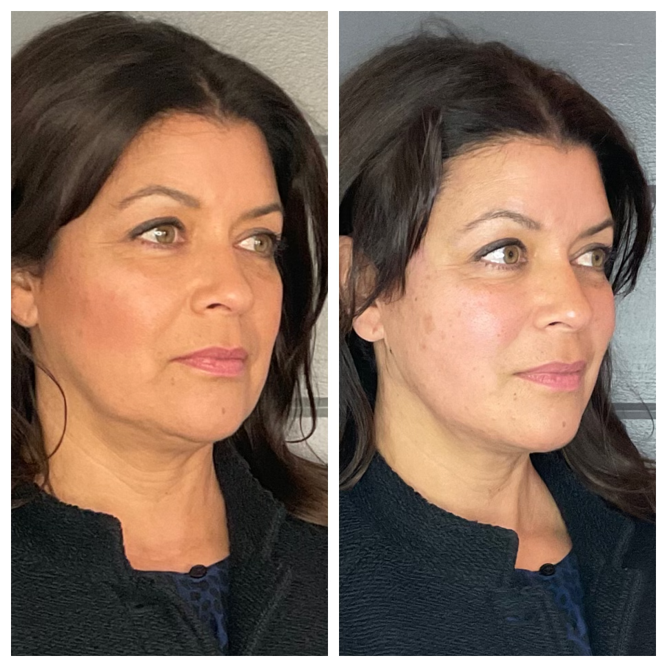 Thread Lifts: The Secret to a Youthful Appearance Without Surgery