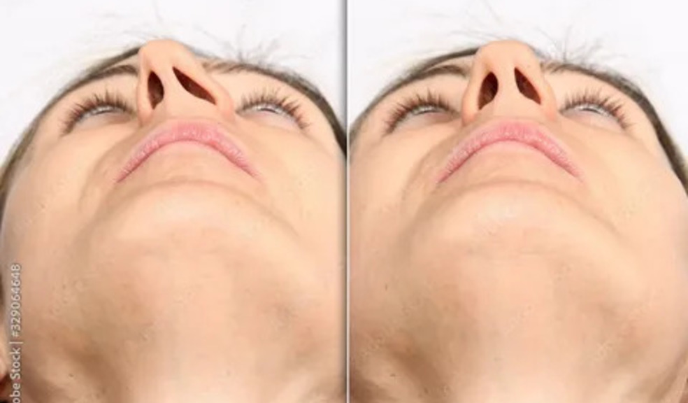 Best Septoplasty Surgeons in Dubai – Improve Your Breathing