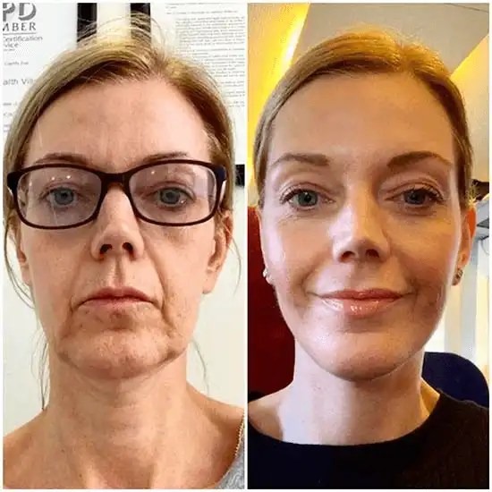 The Ultimate Profhilo Experience with the Best Doctors in dubai