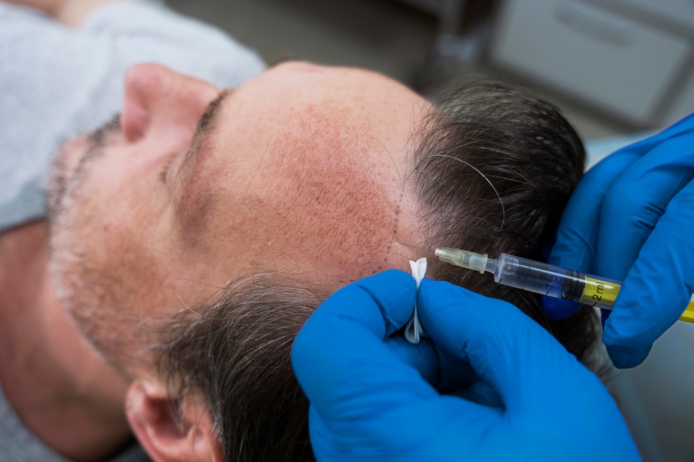 Are Hair Transplants Permanent? Understanding Longevity and Care