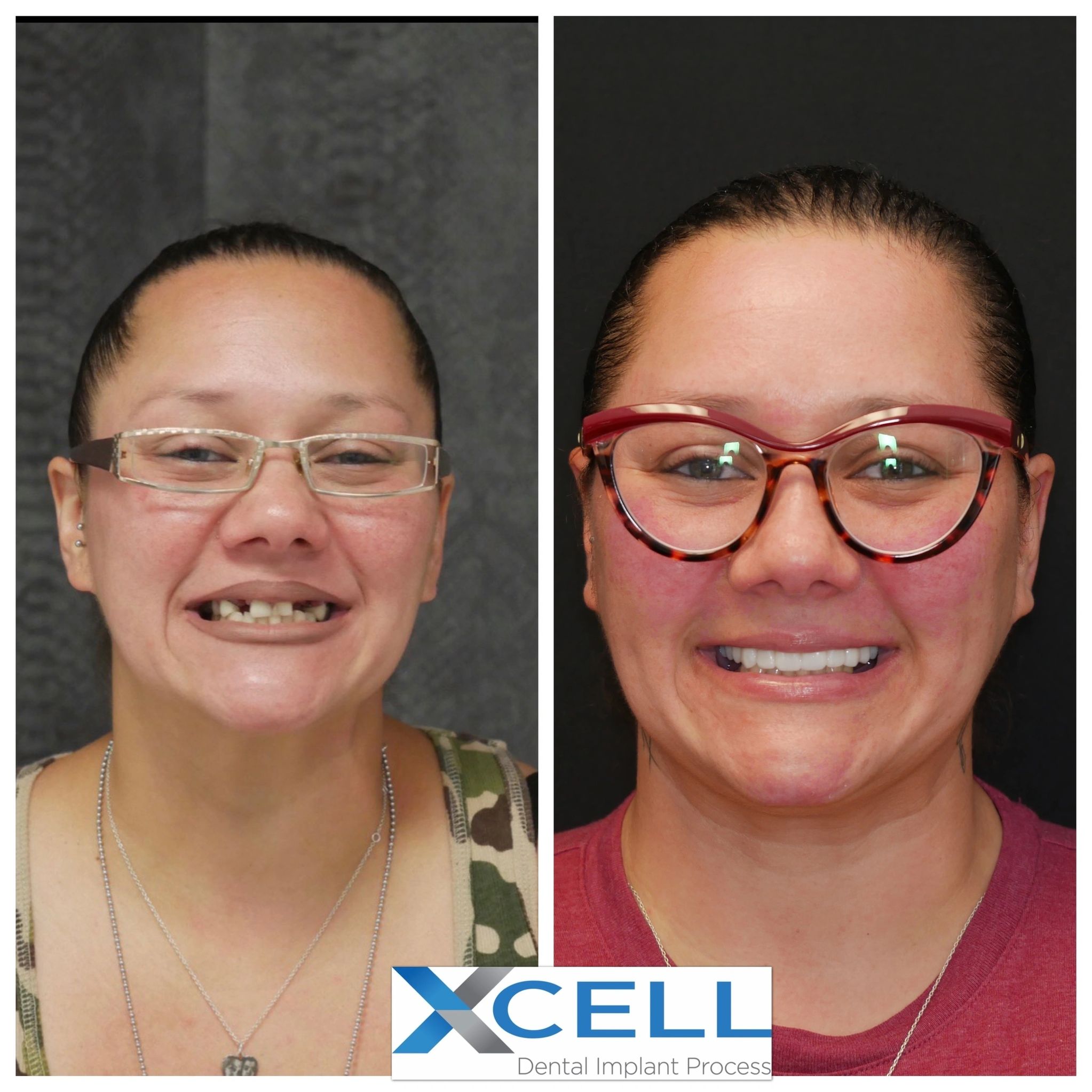 High-Quality Dental Implants: The Ultimate Solution for a Confident Smile