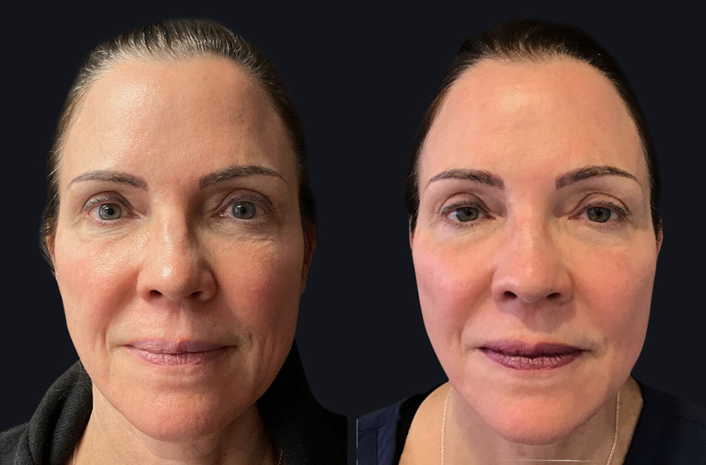 Fractional CO2 Laser Treatment: Cost Analysis for Facial Rejuvenation