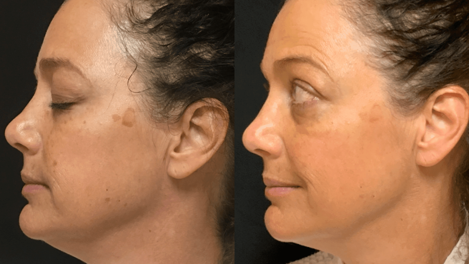 The Cost of Pico Laser Treatment: Is It Affordable for Everyone?