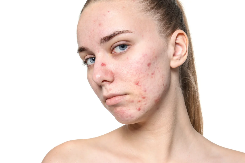 The Role of Gut Health in Acne: Probiotics and Skin Clarity