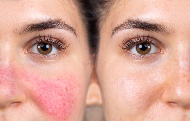Pico Laser: A Fast and Efficient Treatment for Skin Problems