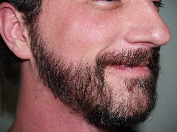 Are You Eligible for a Beard Transplant in Dubai?