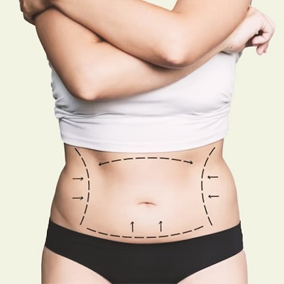 Is Fat Transfer Breast Augmentation Better Than Implants?