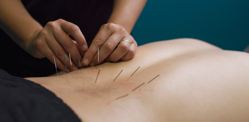 Does Dry Needling Therapy Work for Sports Injuries?