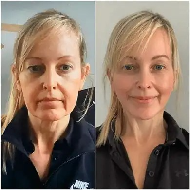Best Doctors in dubai Enhancing Skin with Profhilo Innovation