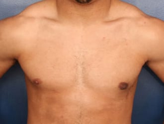 Understanding Gynecomastia Surgery in Dubai