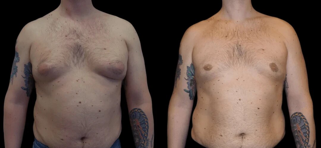 Gynecomastia Surgery in dubai: How Experts Achieve Natural-Looking Results