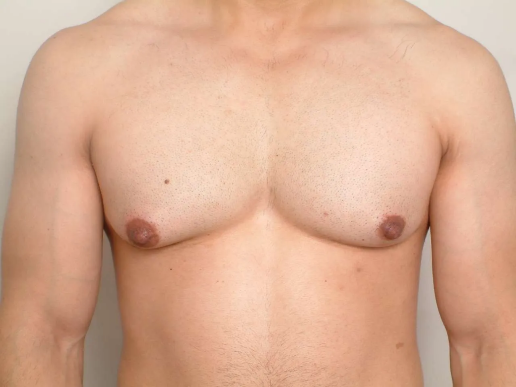 Male Breast Pain: Is It Gynecomastia or Something Else?