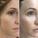 Superficial Chemical Peels or Deep Peels Explained