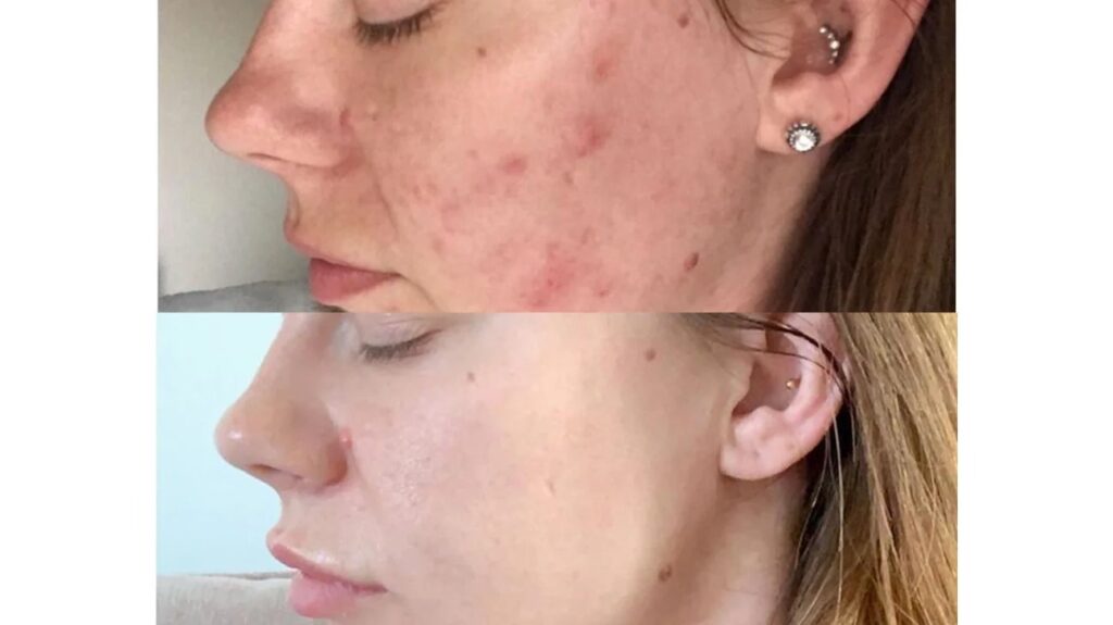 The Benefits of Regular Superficial Chemical Peels