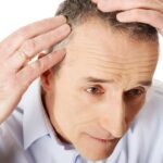 Hair Transplants: Can You Get Coverage for the Cost?