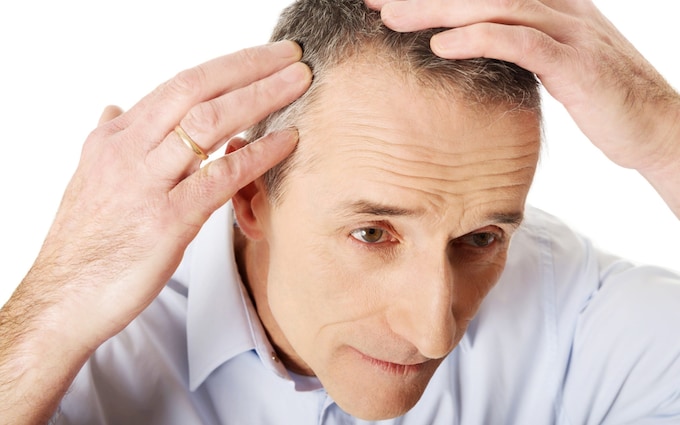 Hair Transplants: Can You Get Coverage for the Cost?