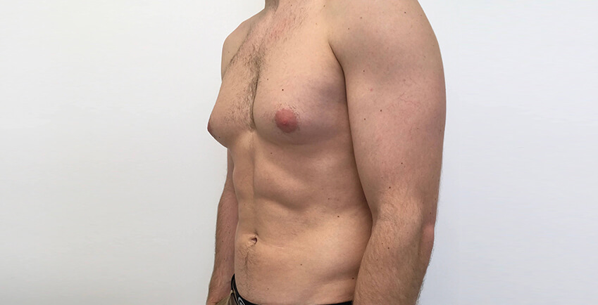 The Science Behind Gynecomastia: Why It Happens and How to Treat It