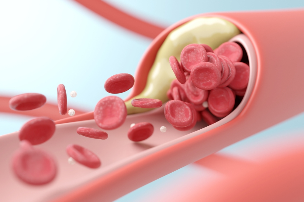 Atherosclerosis vs. Arteriosclerosis: Causes, Symptoms, and Risks