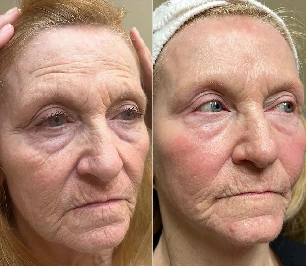 Is the Cost of Fractional CO2 Laser Treatment Justified for Skin Improvement?