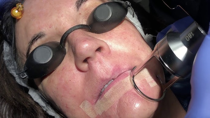 Fractional CO2 Laser for Skin Discoloration: Effective and Gentle
