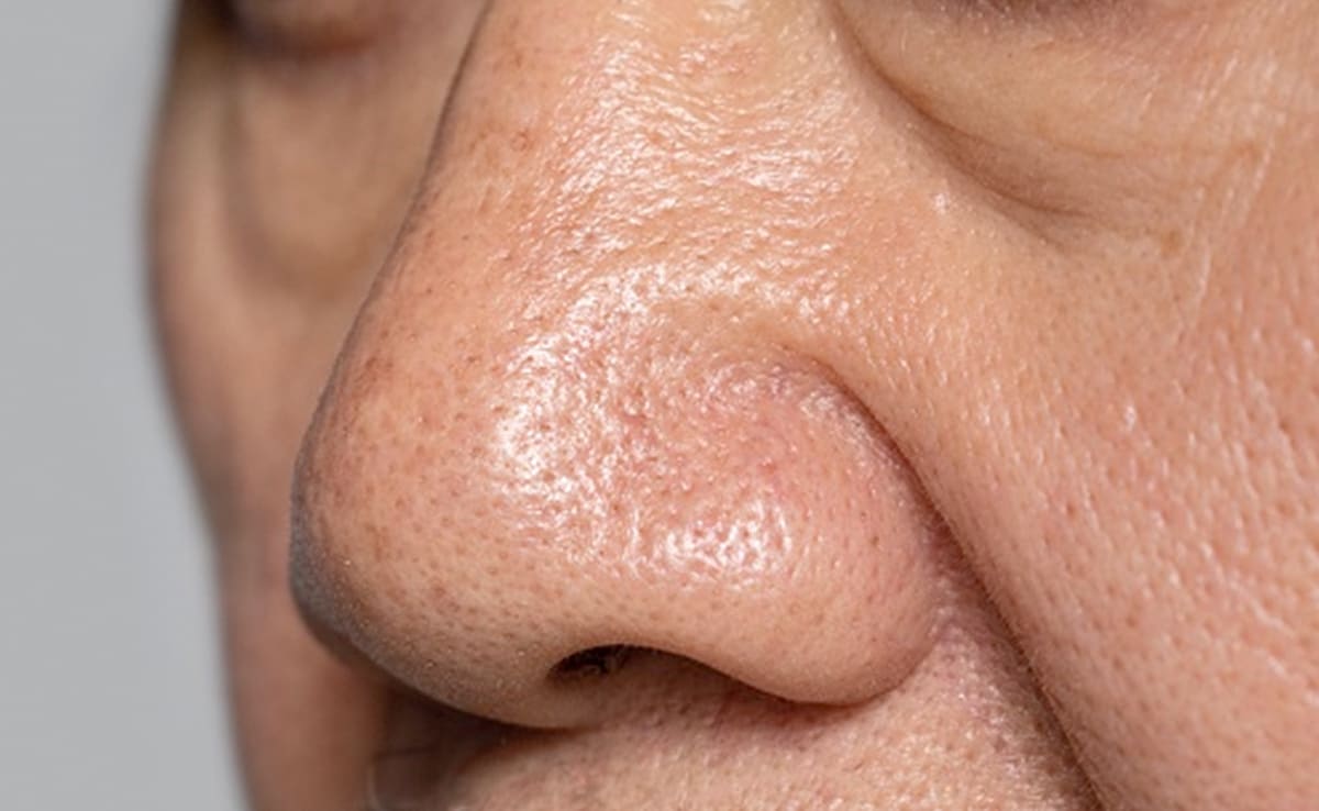 How Much Does Fractional CO2 Laser Treatment Cost for Large Pores?