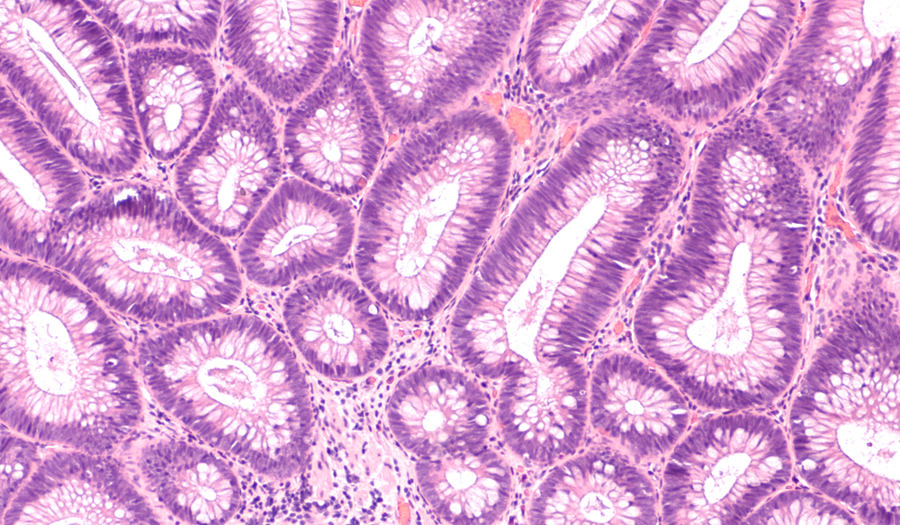 What Is Tubular Adenoma of the Colon? An Overview