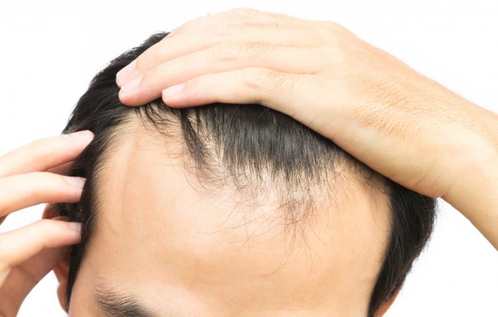 Hairline Goals with Front Line Fix