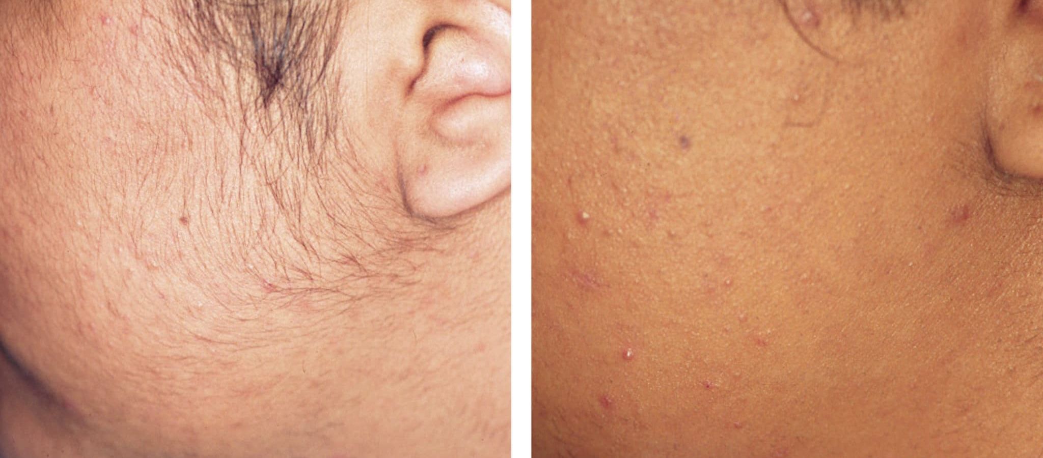 A Safe Hair Removal Option for Dark Skin: Electrolysis in Dubai