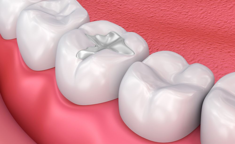 Tooth Filling Cost for First-Timers