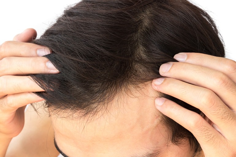 Finasteride for Hair Loss: Is It Right for Your Type of Baldness?