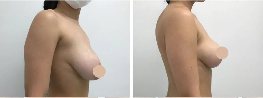 Why the Best Doctors in Dubai Are the Most Trusted for Breast Lift Surgery