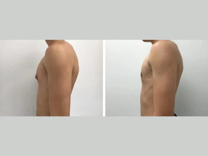 Gynecomastia Correction in Dubai: A Life-Changing Procedure