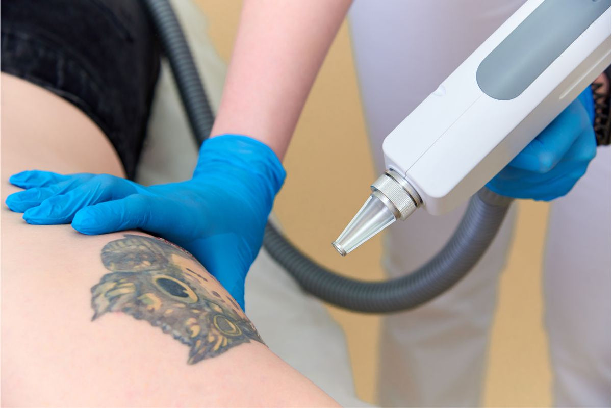 Understanding Tattoo Removal: Important Facts and Tips