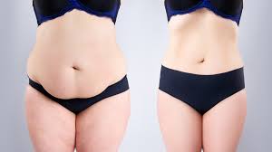 Tummy Tuck Surgery In Dubai – Abdominoplasty