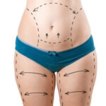 What Are the Risks of Tummy Tuck Surgery in Dubai, and How Can They Be Minimized