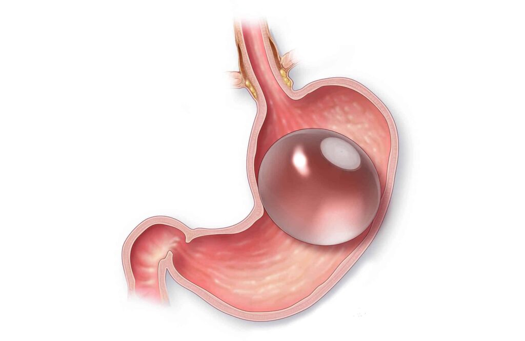 Gastric Balloon Placement Guide