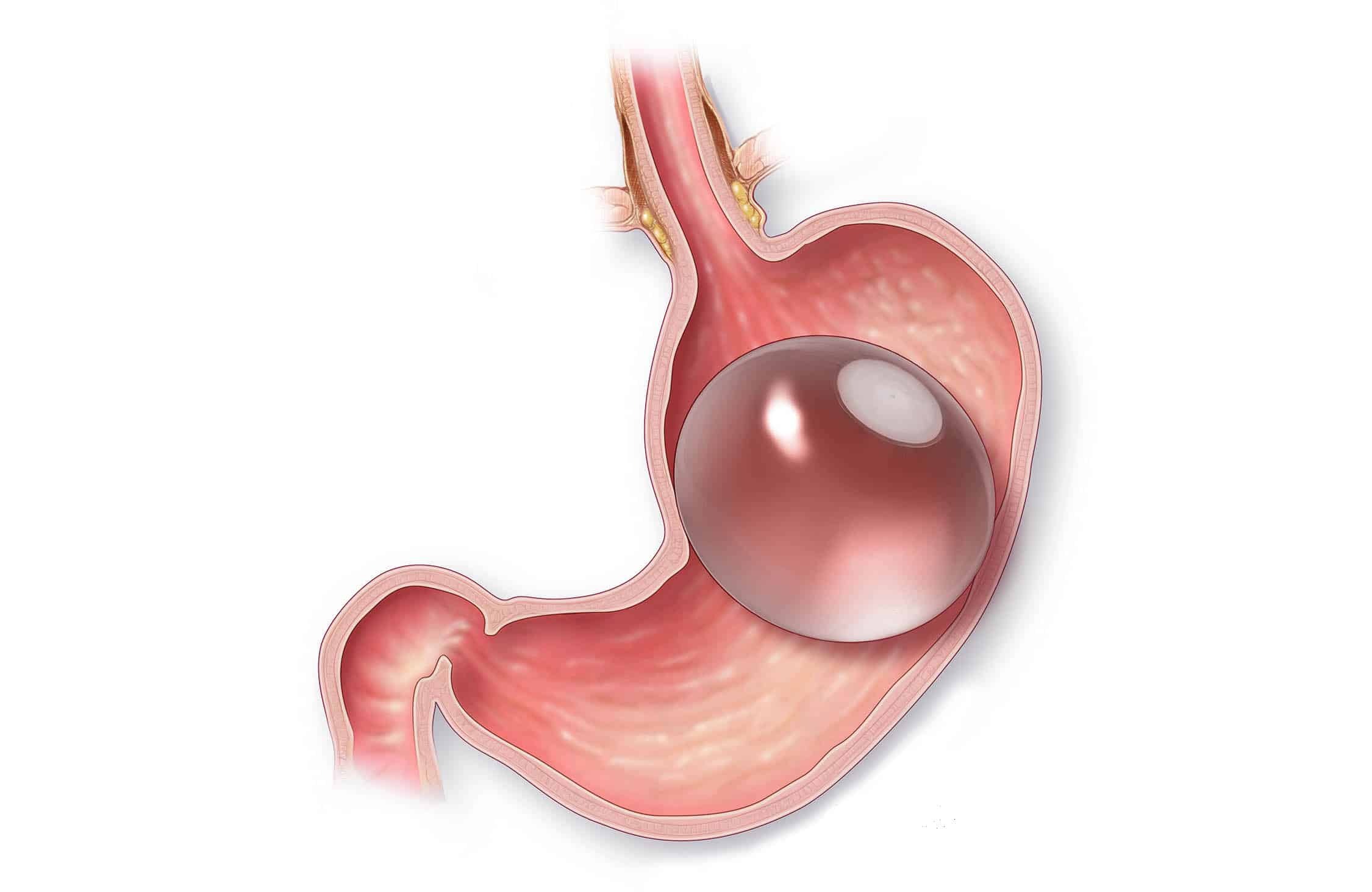 Gastric Balloon Placement Guide