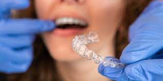 Invisalign Brace : A New Approach to Straightening Teeth