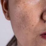 Do Chemical Peels Really Help Fade Melasma?