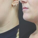 How does double chin liposuction work?