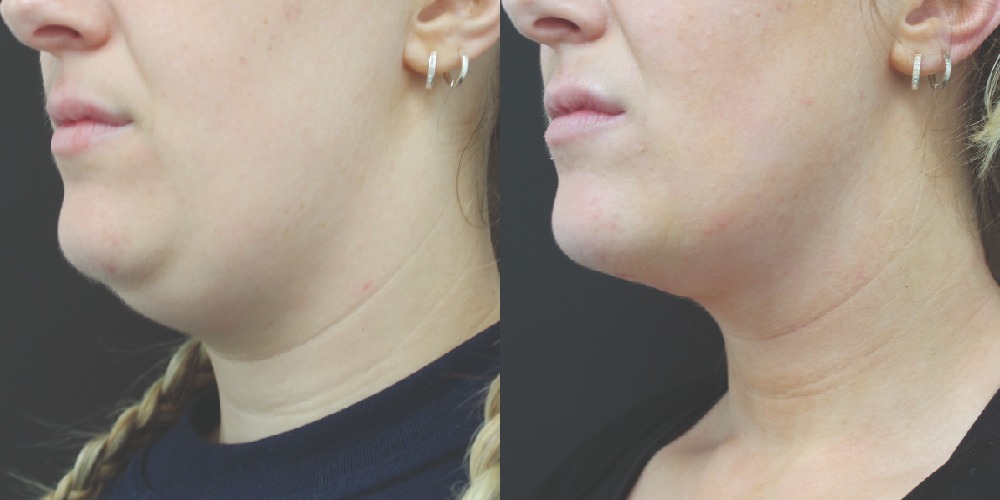 How does double chin liposuction work?